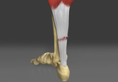 Achilles Tendinitis