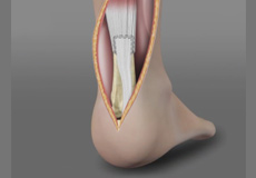 Achilles Tendon Repair