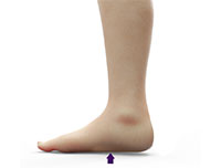 Adult Flatfoot