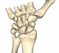 Scapho-lunate Reconstruction – ANAFAB