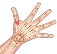 Arthritis of the Hand and Wrist