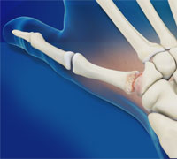 Arthritis Surgery for Thumb and Digits