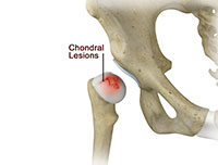 Chondral Lesions or Injuries