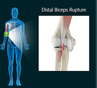 Distal Biceps Rupture