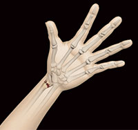 Distal Radius Fracture