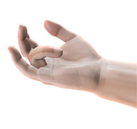 Dupuytren’s Contracture