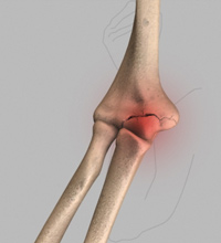 Elbow (Olecranon) Fractures
