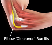 Elbow (Olecranon) Bursitis