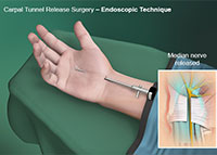 Endoscopic Carpal Tunnel Repair