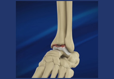 Foot & Ankle Osteoarthritis