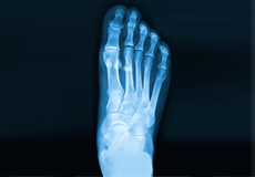 Stress Fracture of the Foot