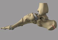 Fracture of the Calcaneus