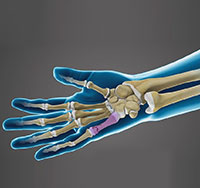 Fractures of the Hand and Fingers