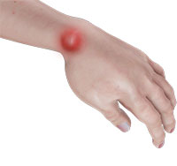 Ganglion Cyst