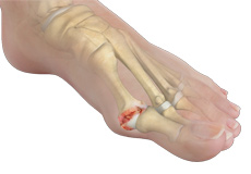 Hallux Rigidus