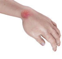 Hand Infections