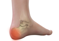 Heel Pain