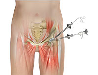 Hip Arthroscopy