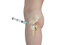 Hip Injections