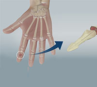 Joint Fusions of the Fingers & Wrist