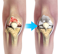 Unicompartmental Knee Replacement