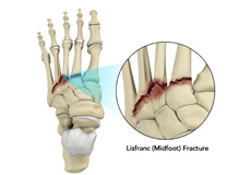Lisfranc (Midfoot) Injury 