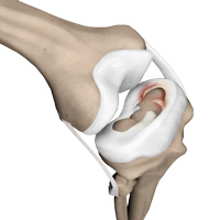 Meniscal Tears