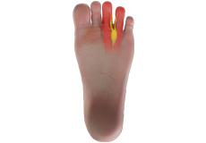 Morton's Neuroma