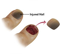 Nailbed Injuries