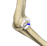 Osteochondritis Dissecans