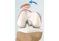 Patellar Dislocation/Patellofemoral Dislocation