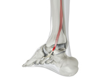 Posterior Tibial Tendon Dysfunction