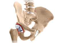 Revision Hip Replacement