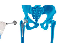 Robotic-assisted Hip Surgery