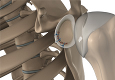 Shoulder Joint Tear