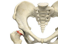 Slipped Capital Femoral Epiphysis