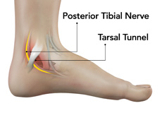 Tarsal Tunnel Syndrome