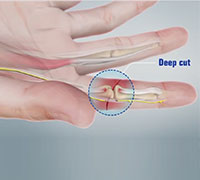 Tendon and Nerve Laceration