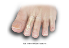 Toe and Forefoot Fractures