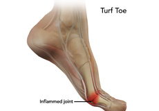 Turf Toe