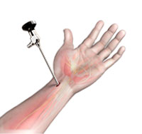 Wrist Arthroscopy