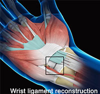 Wrist Ligament Reconstruction